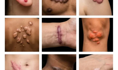 Keloid Treatment