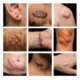 Keloid Treatment